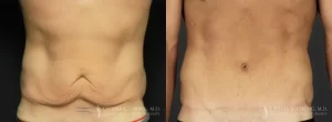 Tummy Tuck male 2