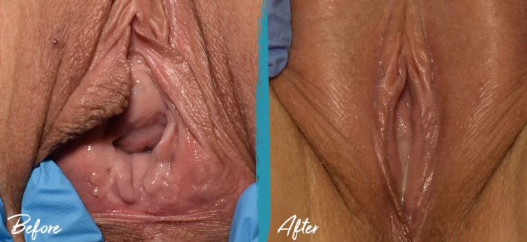 Vagina Correction and Tightening fat reduction, clitoral hood reduction