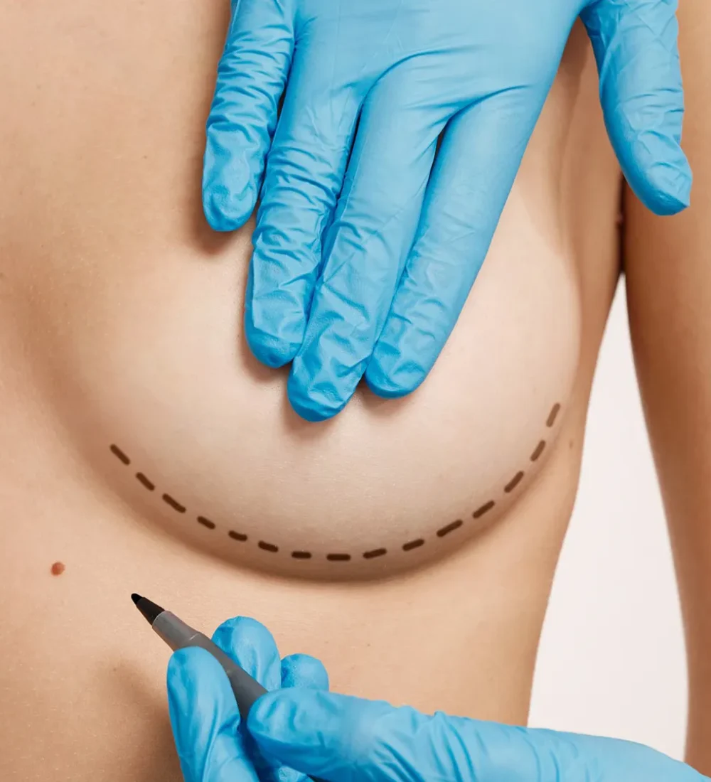 Breaast Augmentation