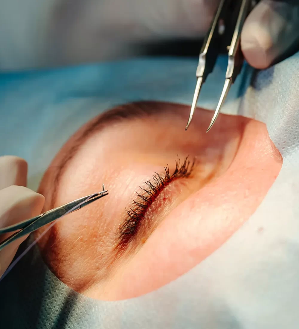 Eyelid surgery