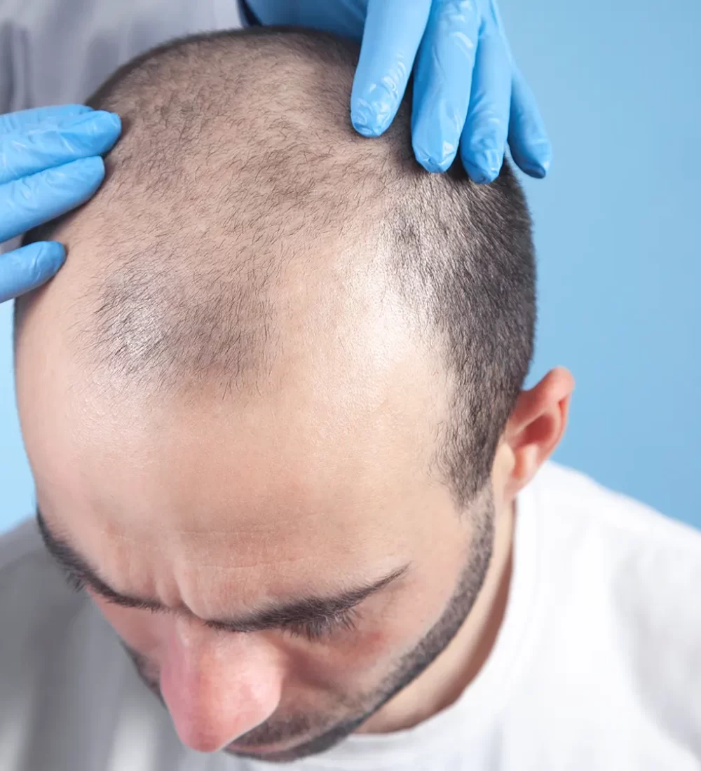Hair restoration male