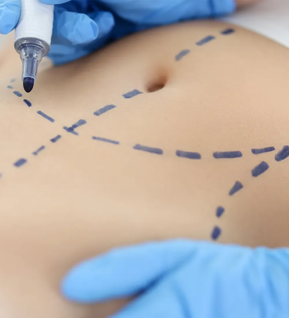 Liposuction