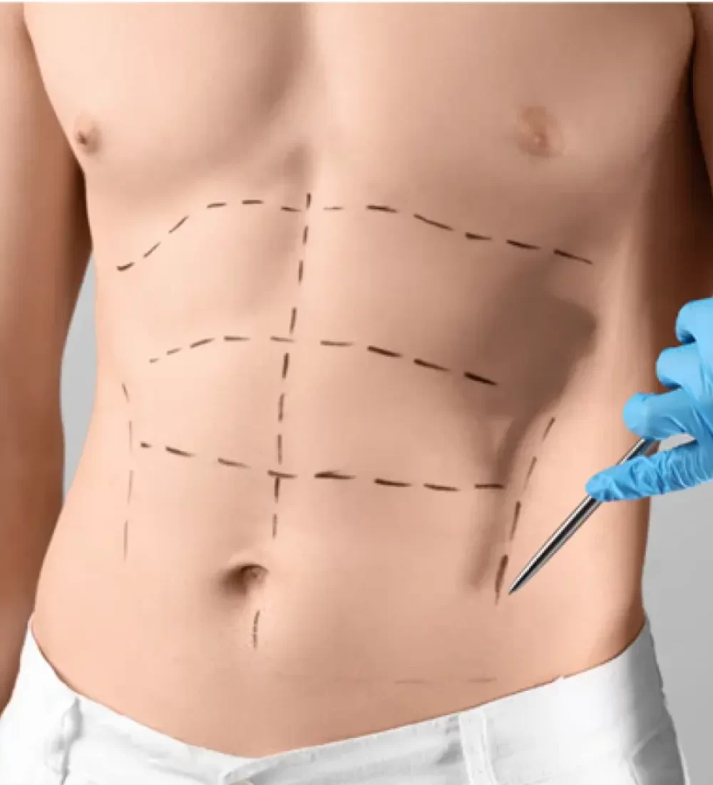 Tummy Tuck male cover